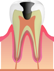 C3:歯の神経にまで達した虫歯