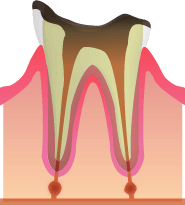 C4:歯の根元だけが残っている虫歯